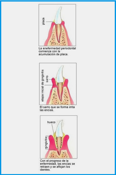 Qué son las enfermedades periodontales
