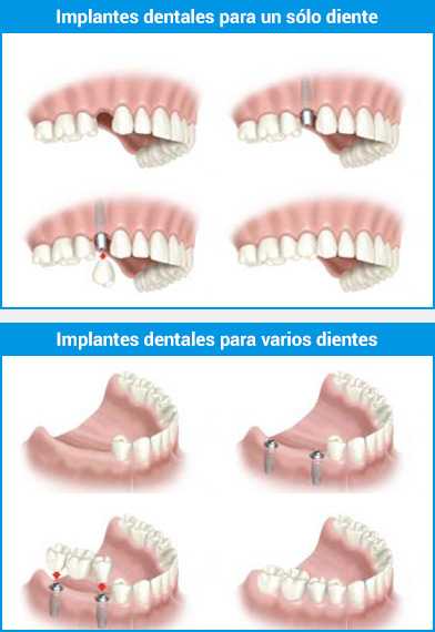 Qué son los implantes dentales