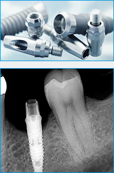 Qué son los implantes dentales